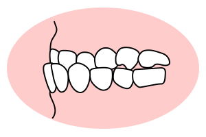 反対咬合（受け口）